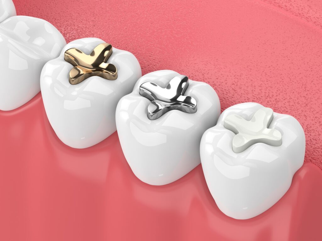 A 3D illustration of molars with gold, silver, and white dental fillings, showing restorative treatment options.