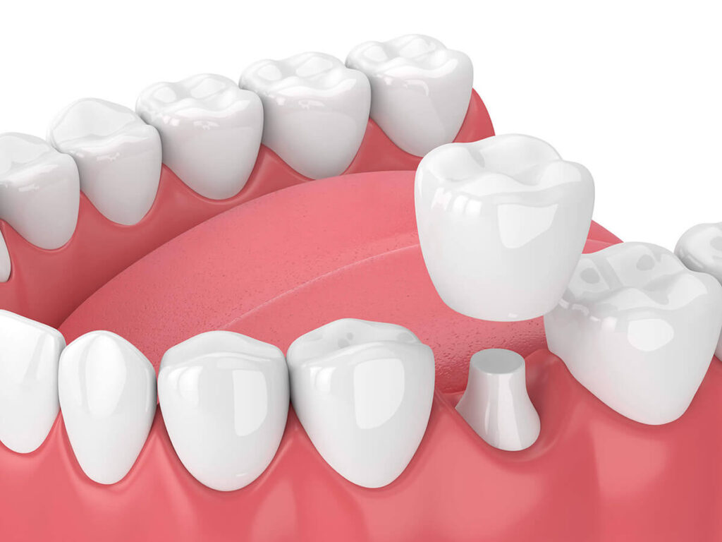 A digital 3D image of a dental crown being placed over a prepared tooth, illustrating restorative dentistry